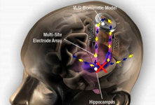 記憶芯片植入大腦 或解決老年癡呆