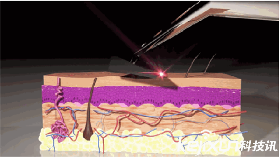 激光剃須刀： 無需換刀頭 每天享受干凈臉容