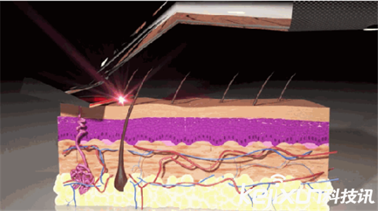 激光剃須刀： 無需換刀頭 每天享受干凈臉容